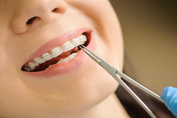 Braces Specialist: Your Path To Straighter Teeth