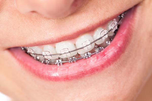 Braces Have Changed, From Metal to Tooth-Colored to Clear