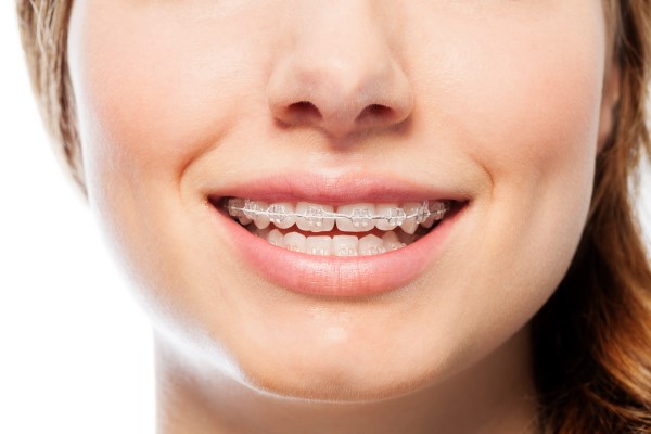 Why Choose Ceramic Braces? Benefits And Considerations