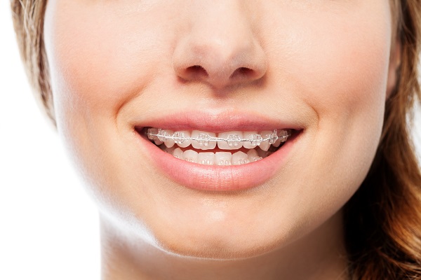 Why Clear Braces for Teens Are Recommended - Tennison Orthodontics